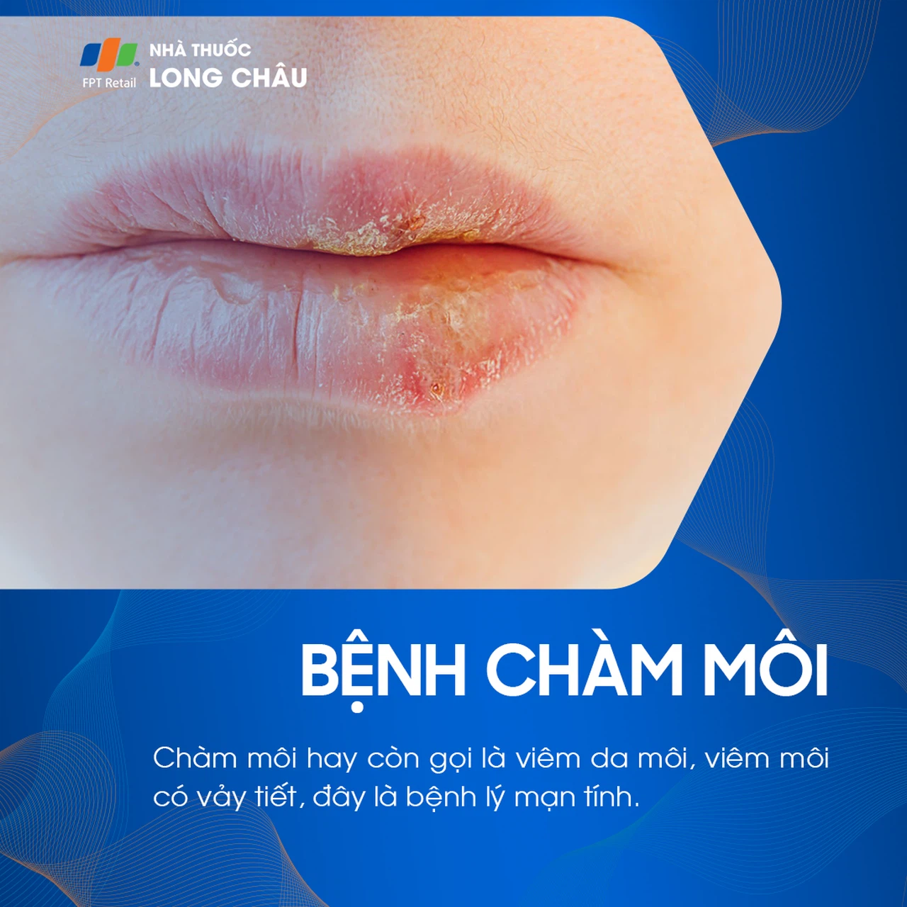 Chàm Môi Bôi Thuốc Gì