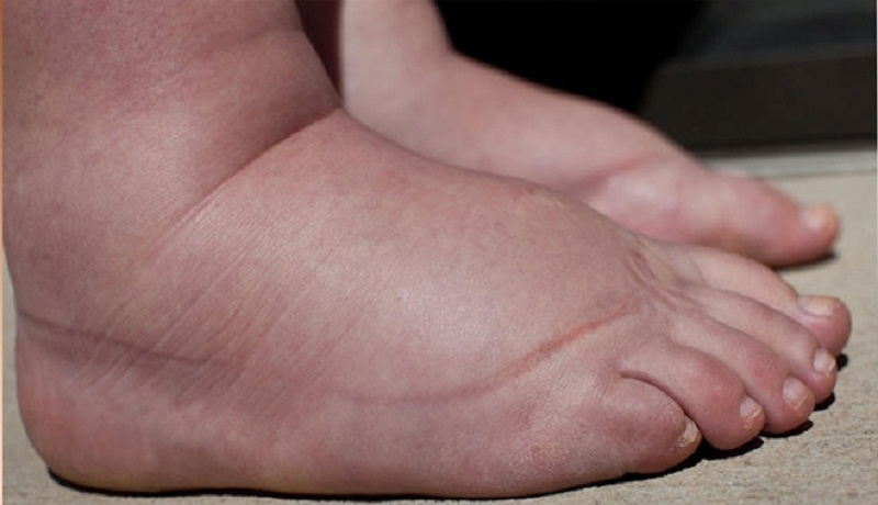 Chân Bị Phù ở Người Già
