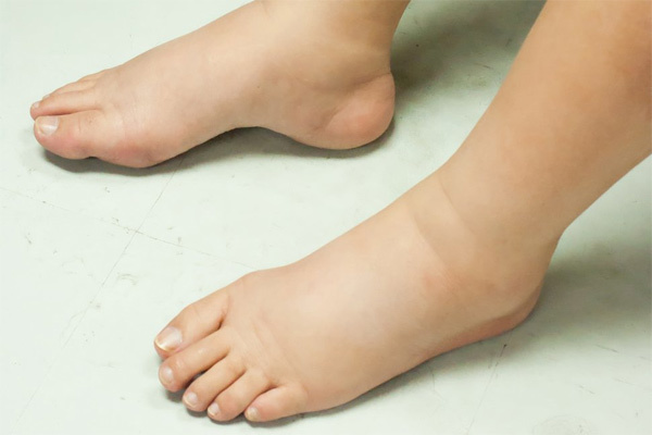 Chân Bị Sưng Nhưng Không đau