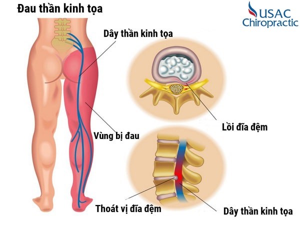 Chân Bị Tê Mất Cảm Giác