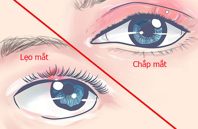 Chắp ở Mắt