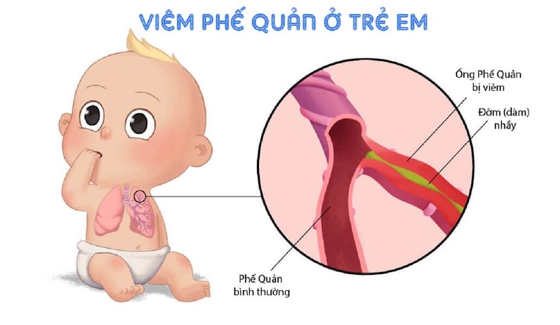 Co Thắt Phế Quản ở Trẻ