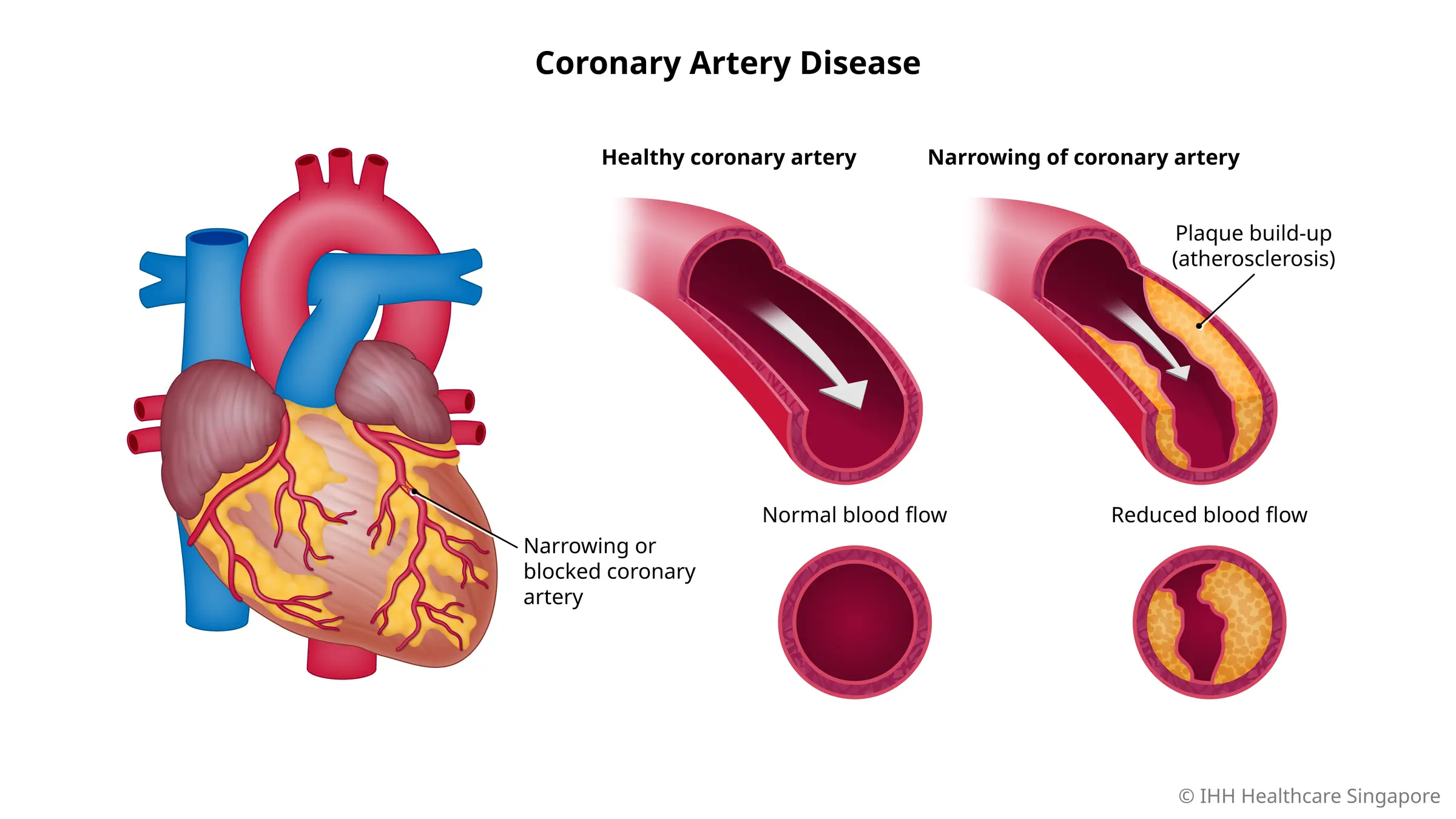 Coronary Heart Disease Là Gì