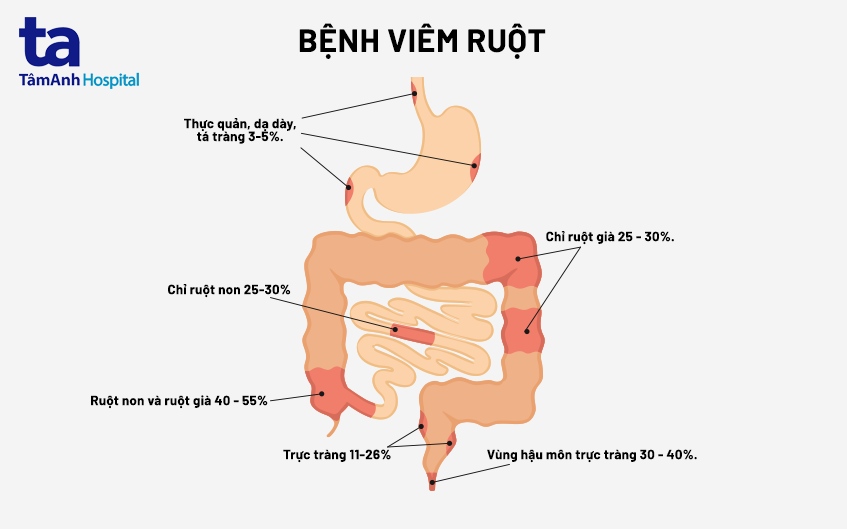 Crohn's Disease Là Gì