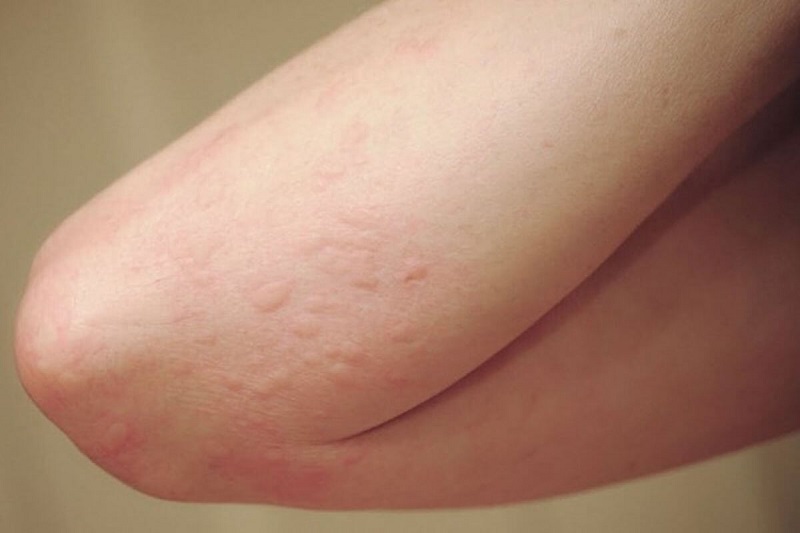 Da Bị Nổi Mẩn Ngứa
