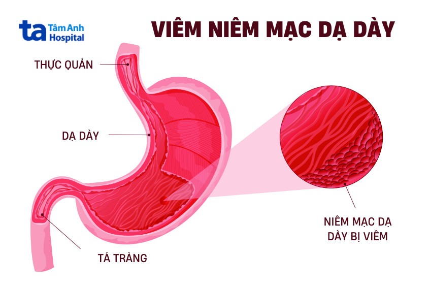 Da Niêm Là Gì