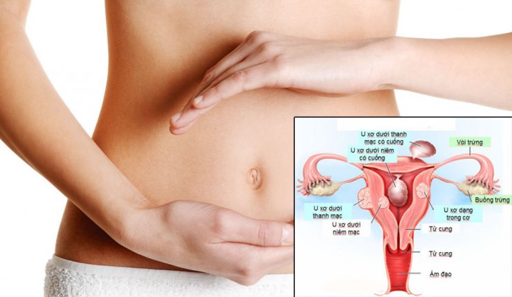đau Bụng Dưới Từng Cơn ở Nữ