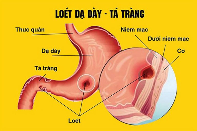 đau Dạ Dày Tá Tràng