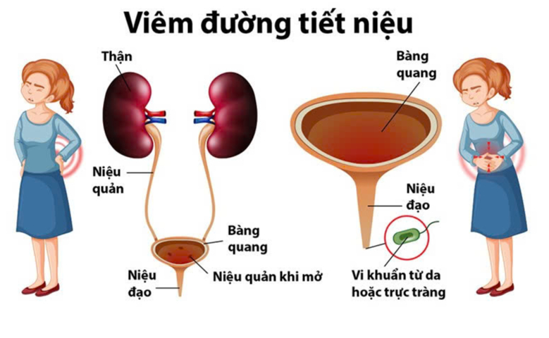 đau đường Tiết Niệu