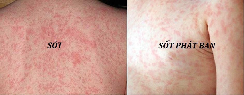 Dấu Hiệu Của Sởi