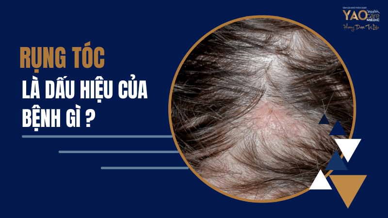 Dấu Hiệu Rụng Tóc