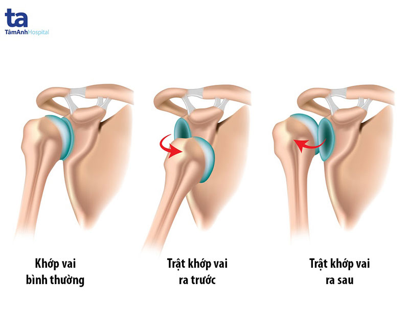 Dấu Hiệu Trật Khớp Vai
