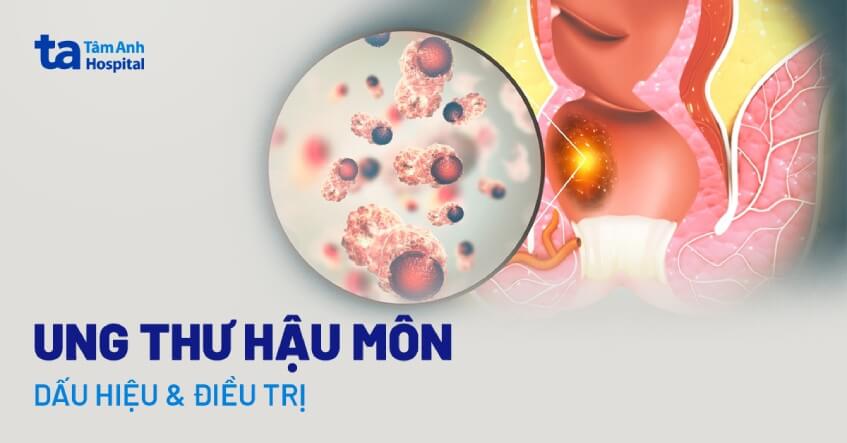 Dấu Hiệu Ung Thư Hậu Môn