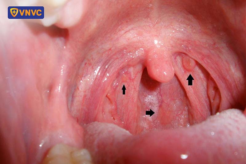 Dấu Hiệu Ung Thư Vòm Họng Sớm Nhất