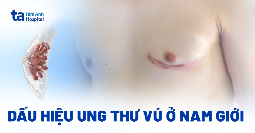 Dấu Hiệu Ung Thư Vú ở Nam Giới