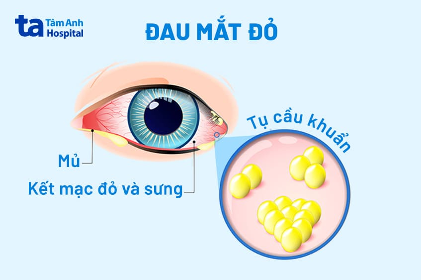 đau Mắt đỏ Do Vi Khuẩn