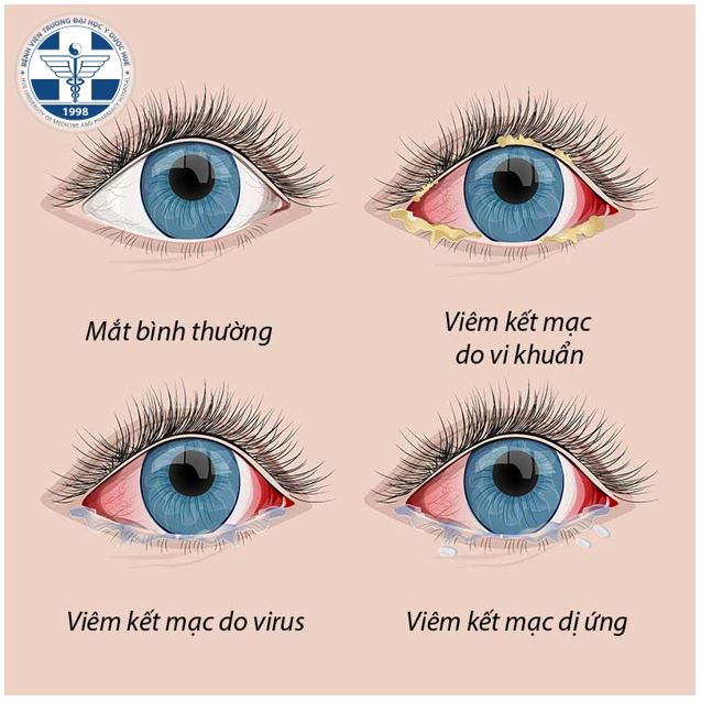 điều Trị Viêm Kết Mạc