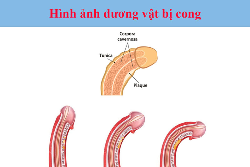 Dương Vật Cong Xuống Có Sao Không