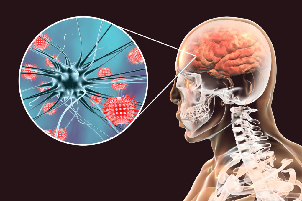 Encephalitis La Gì