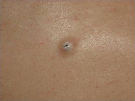 Epidermoid Cyst Là Gì