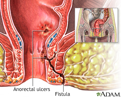 Fistula Là Gì
