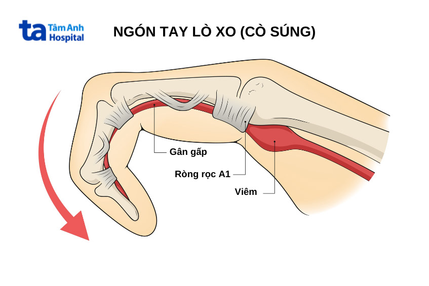 Gân Gấp Ngón Tay