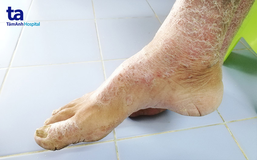 Hình ảnh Bệnh Xơ Cứng Bì