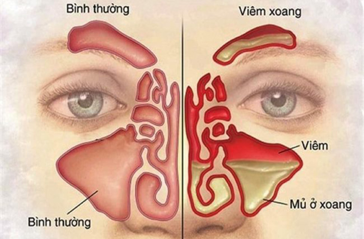 Hình ảnh Mũi Bị Viêm Xoang
