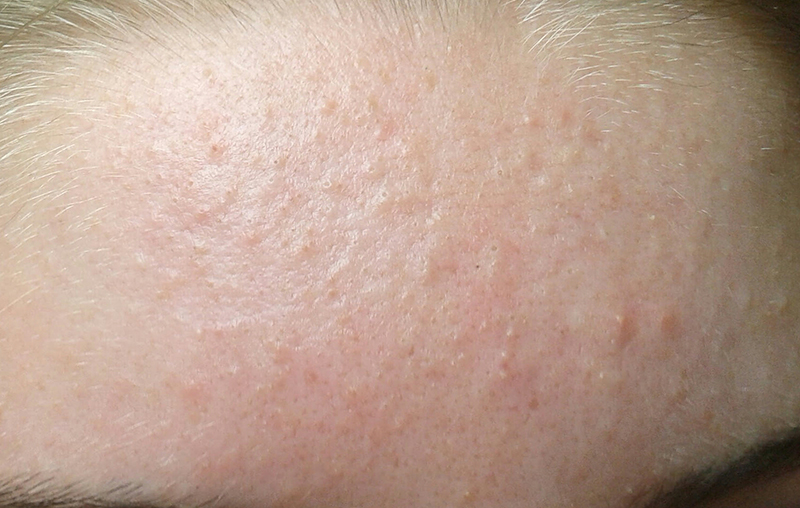 Hình ảnh Mụn ẩn