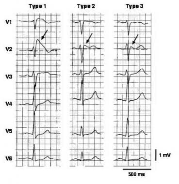 Hội Chứng Brugada Ecg