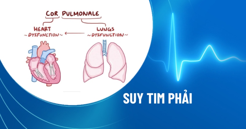 Hội Chứng Suy Tim Phải