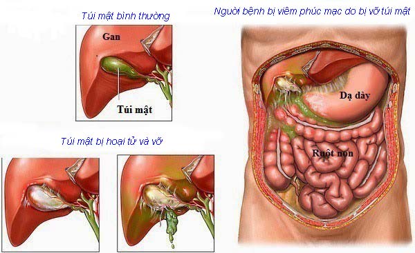 Hội Chứng Viêm Phúc Mạc