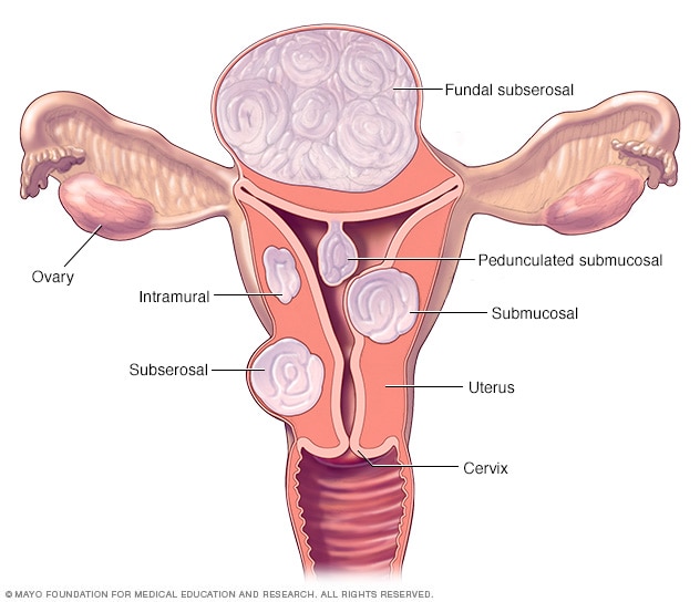 Leiomyoma Là Gì