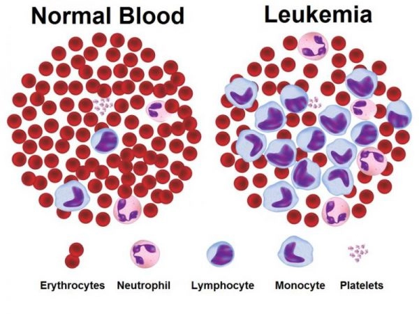 Leukaemia Là Gì