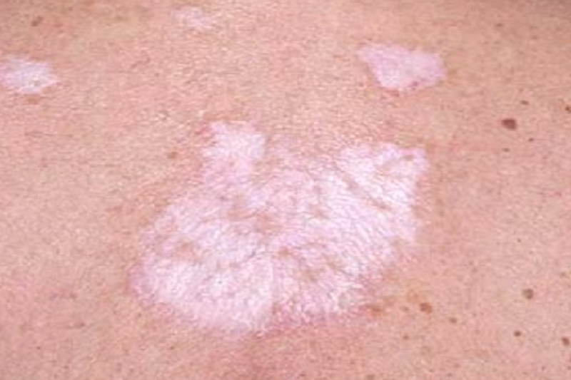 Lichen Hóa Là Gì