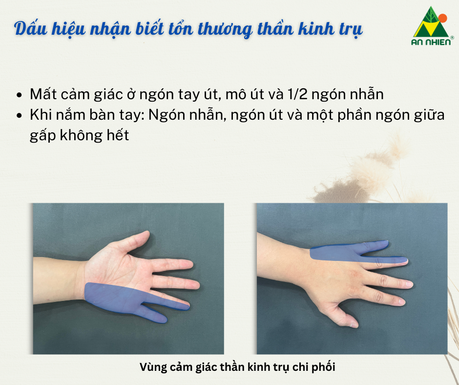 Liệt Thần Kinh Trụ