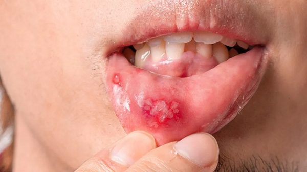 Lở Miệng Nhiệt Miệng