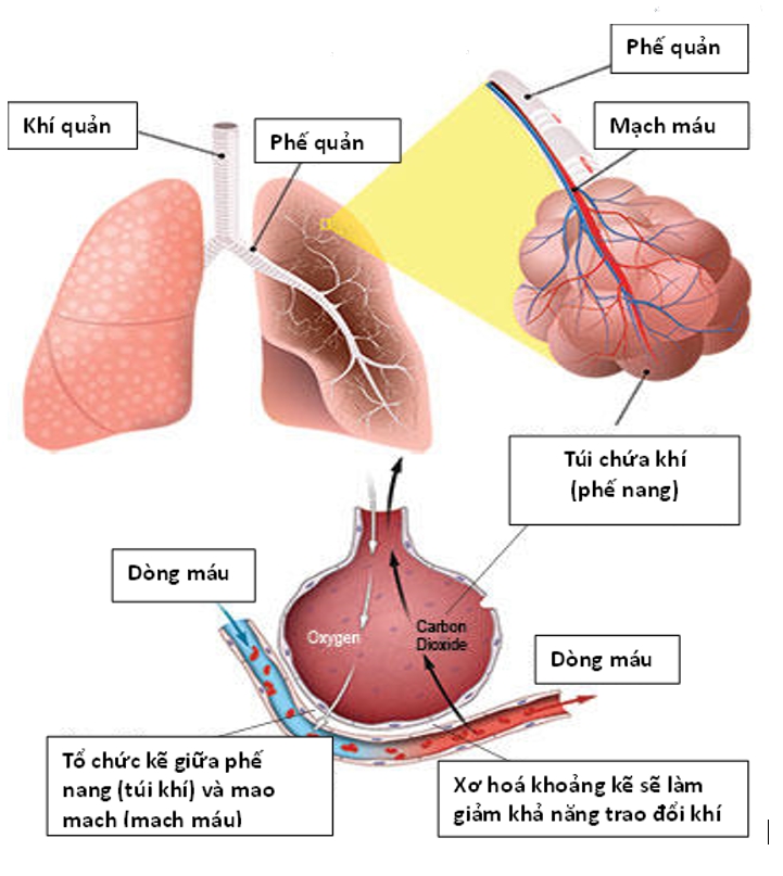 Mô Kẽ Là Gì