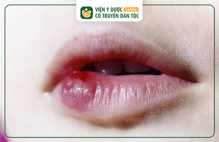 Môi Bị Sưng 1 Cục