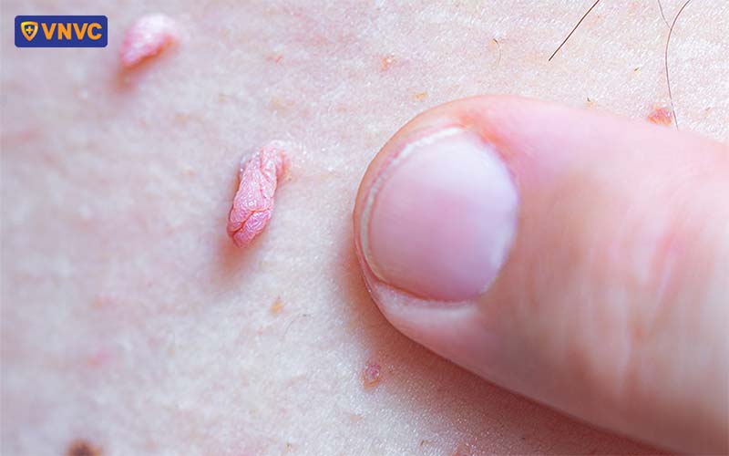 Mụn Cóc Sinh Dục ở Nữ