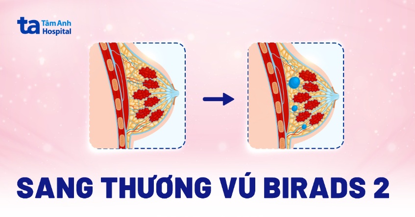 Nang Tuyến Vú Birads 2