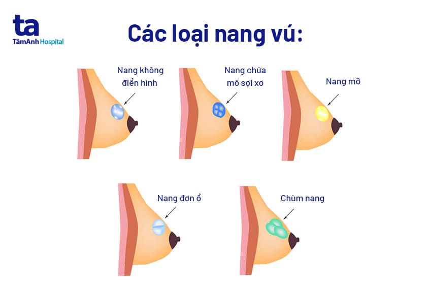 Nang Vú Trái Có Nguy Hiểm Không