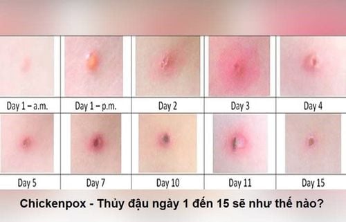 Nguyên Nhân Bệnh Thủy đậu