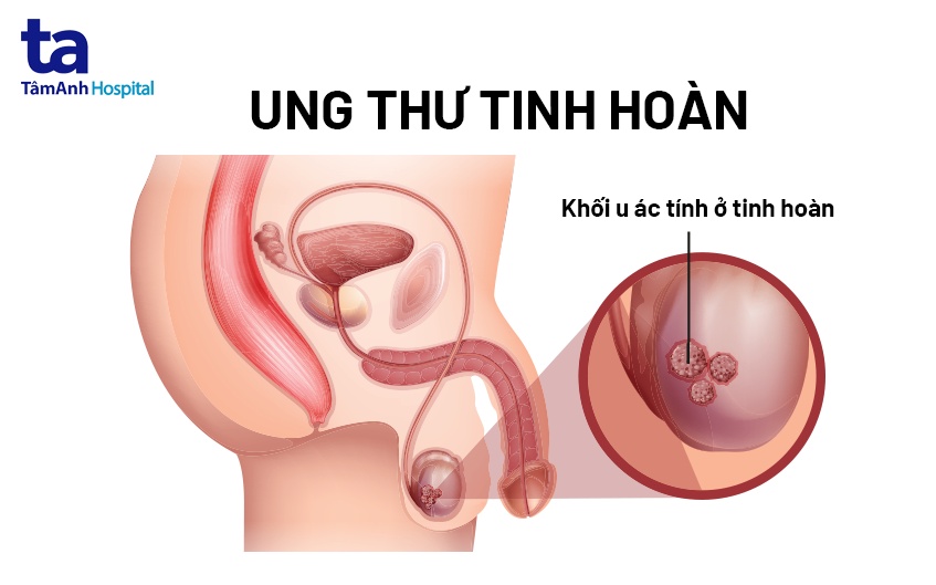Nguyên Nhân đau Tinh Hoàn