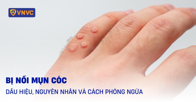 Nguyên Nhân Gây Mụn Cóc