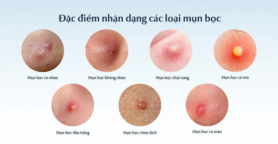 Nguyên Nhân Mụn Bọc