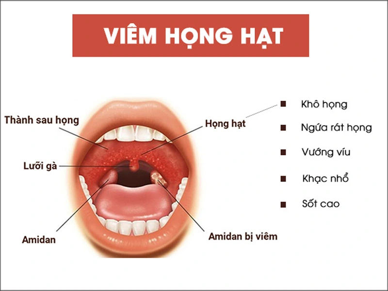 Nguyên Nhân Viêm Họng Hạt