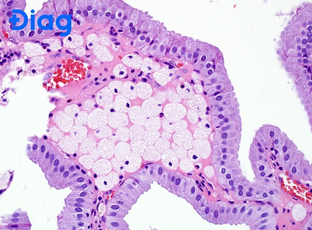 Nhiễm Cholesterol Thành Túi Mật Là Gì