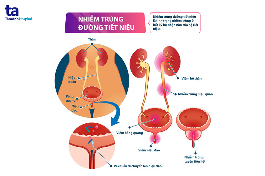 Nhiễm Trùng đường Tiểu Có Nguy Hiểm Không