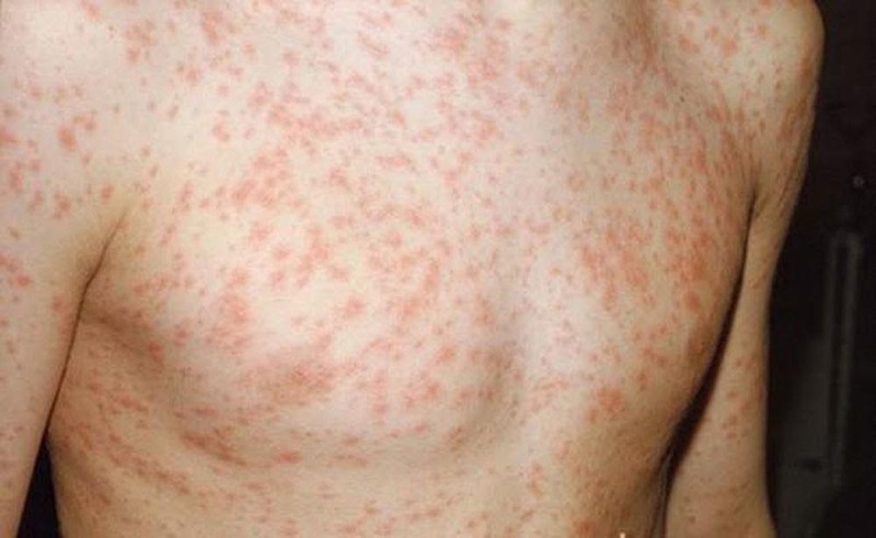 Nổi Ban đỏ Ngứa Khắp Người
